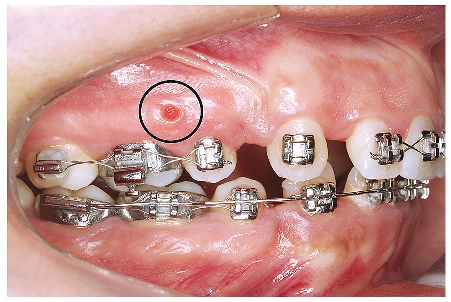 PDF Analysis of Factors Associated with Orthodontic Microscrew Failure