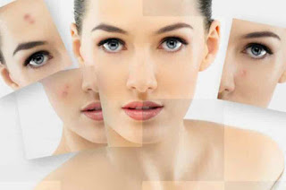 Cara Menghilangkan Noda Flek Hitam Bekas Jerawat Secara Alami Cara Menghilangkan Noda Flek Hitam Bekas Jerawat Secara Alami