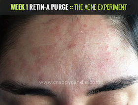 How to Use Retin-A & Survive the Purge :: The Acne How to Use Retin-A & Survive the Purge :: The Acne