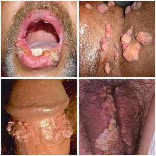 Obat Penyekit Jengger Ayam Obat Penyekit Jengger Ayam