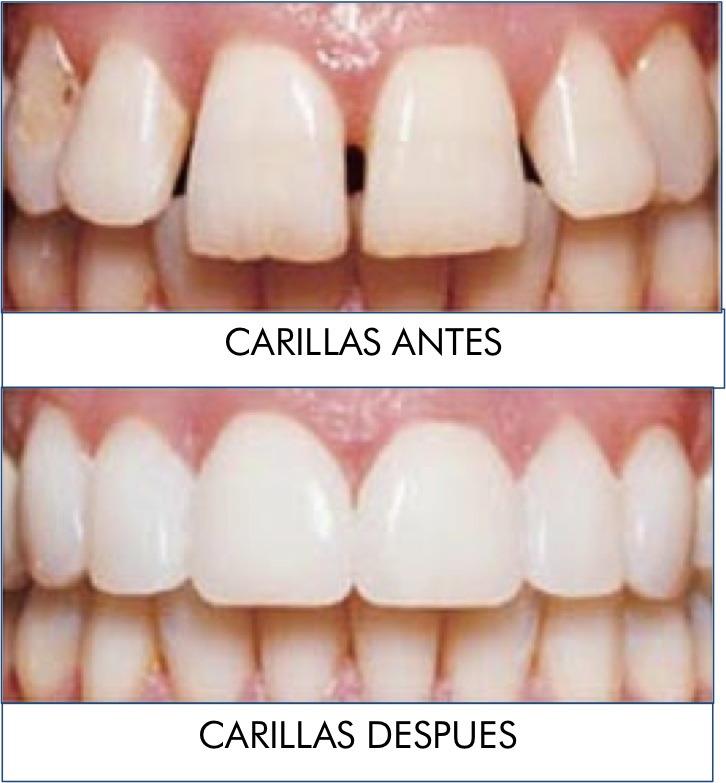 un secreto bien guardado carillas dentales blog sanusdent carillas dentales
