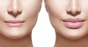 Lip Fillers Lip Fillers Edmonton