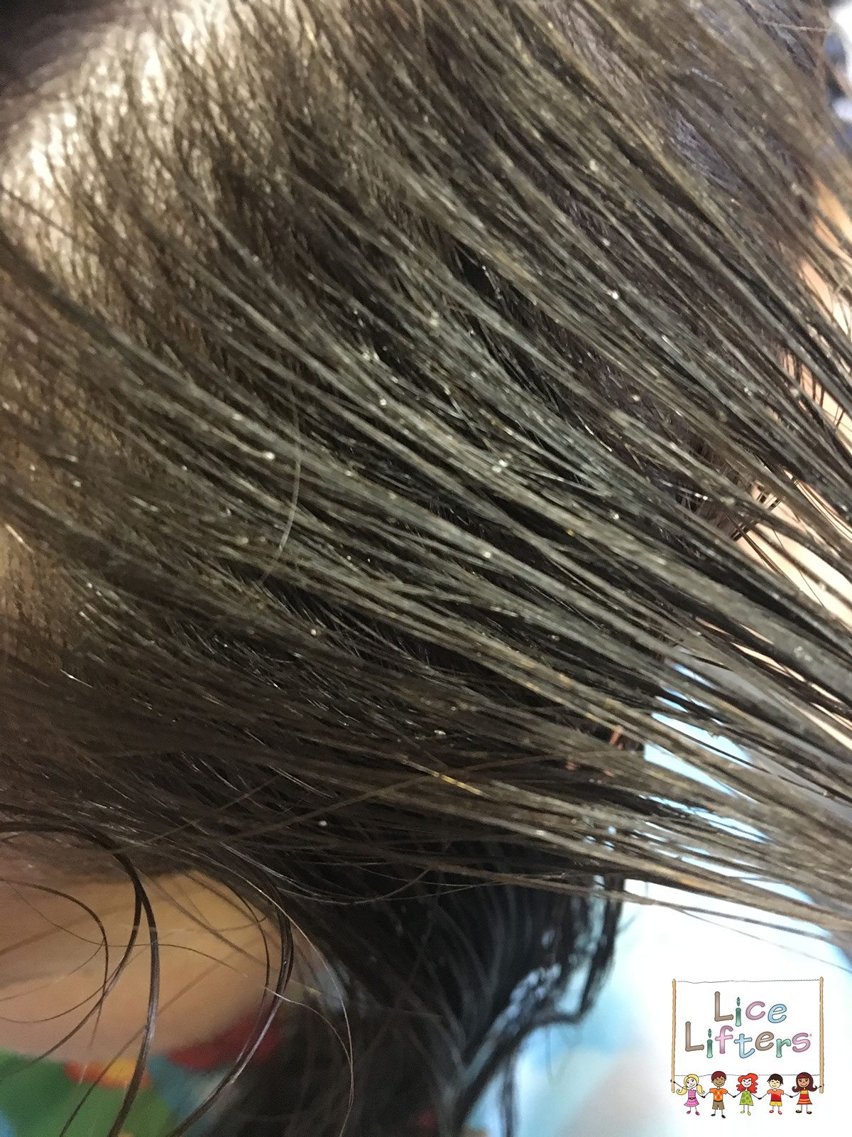 How To Remove Lice From Hair By Your Own Caraway Seeds Health Benefits