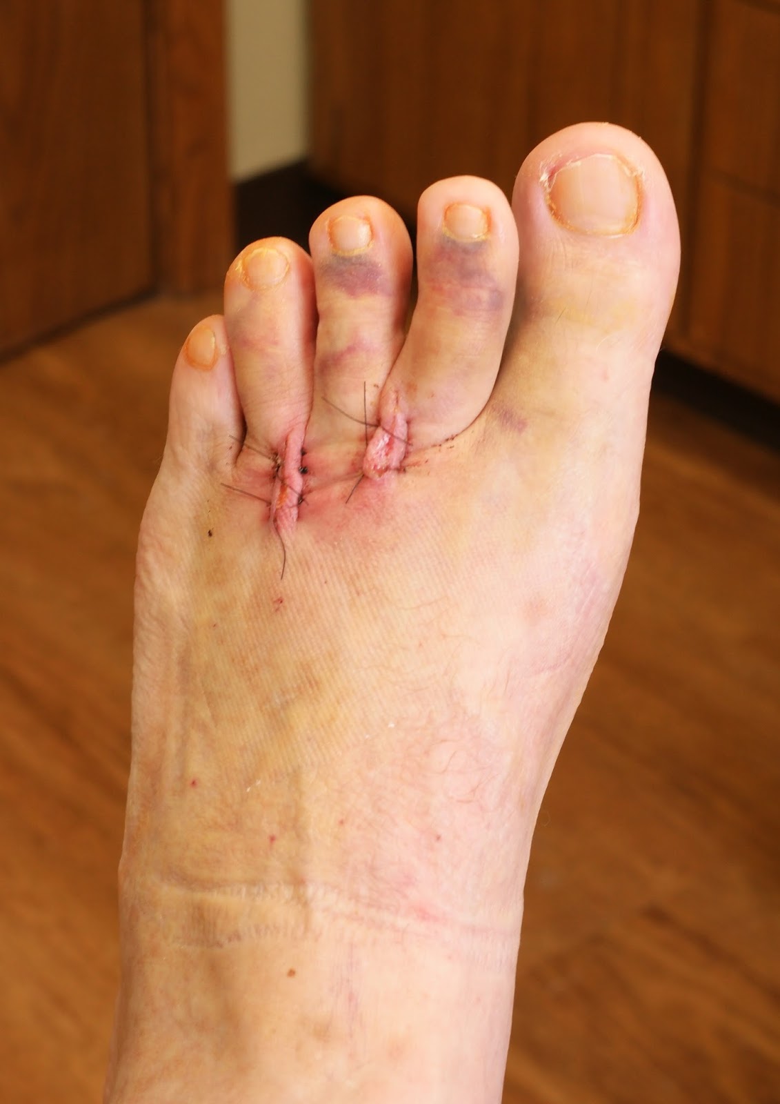 Mark Rehorst's Tech Topics Foot Surgery Excision of