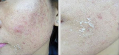 Thâm mụn và cách điều trị an toàn, hiệu quả