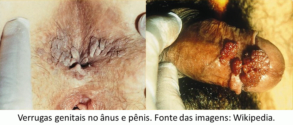 genital herpes syfilis wiki genital herpes syfilis wiki