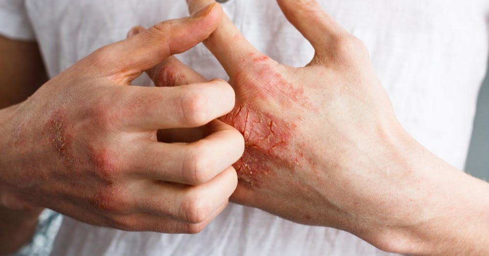 Eczema Definition, causes, and treatment