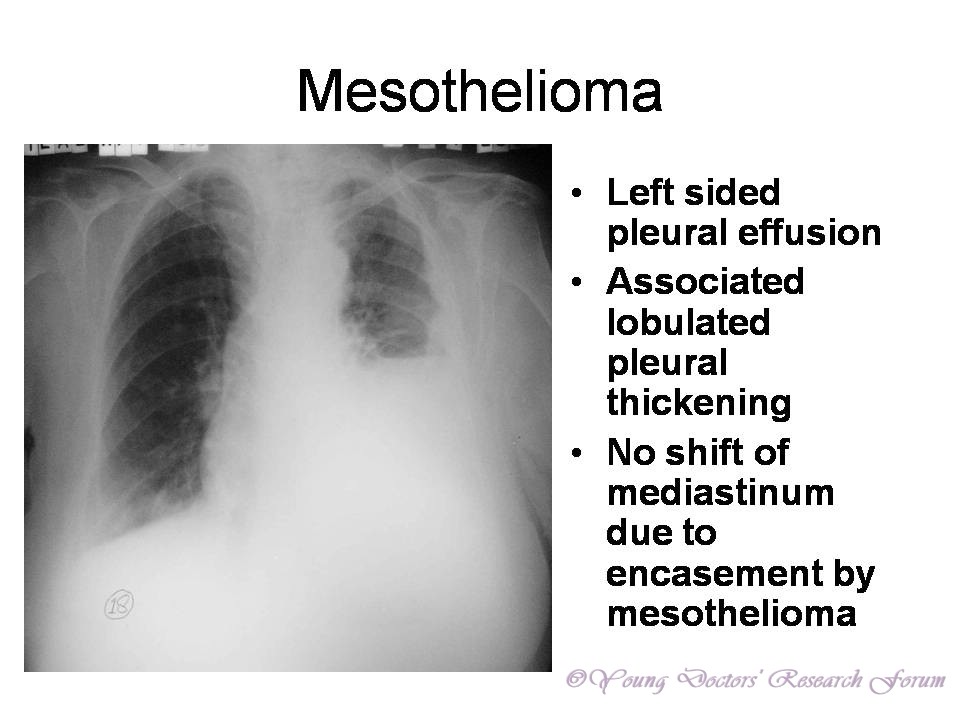 Identification of Chest Xrays of Common Lung Diseases YOUNG DOCTORS