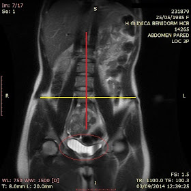 vértebras aplastantes sacro lumbar y erección