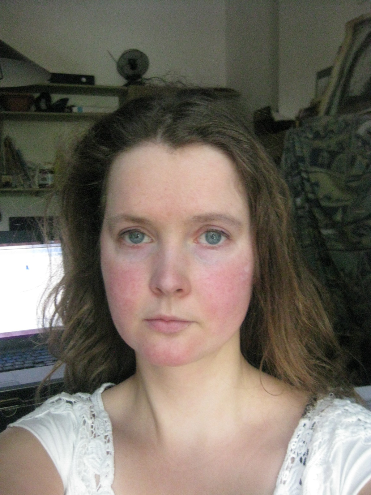 Scarlet Letters, dealing with vascular rosacea, face flushing, burning