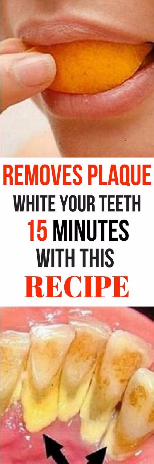REMOVES PLAQUE AND WHITEN YOUR TEETH IN 15 MIN WITH THIS RECIPE THAT A