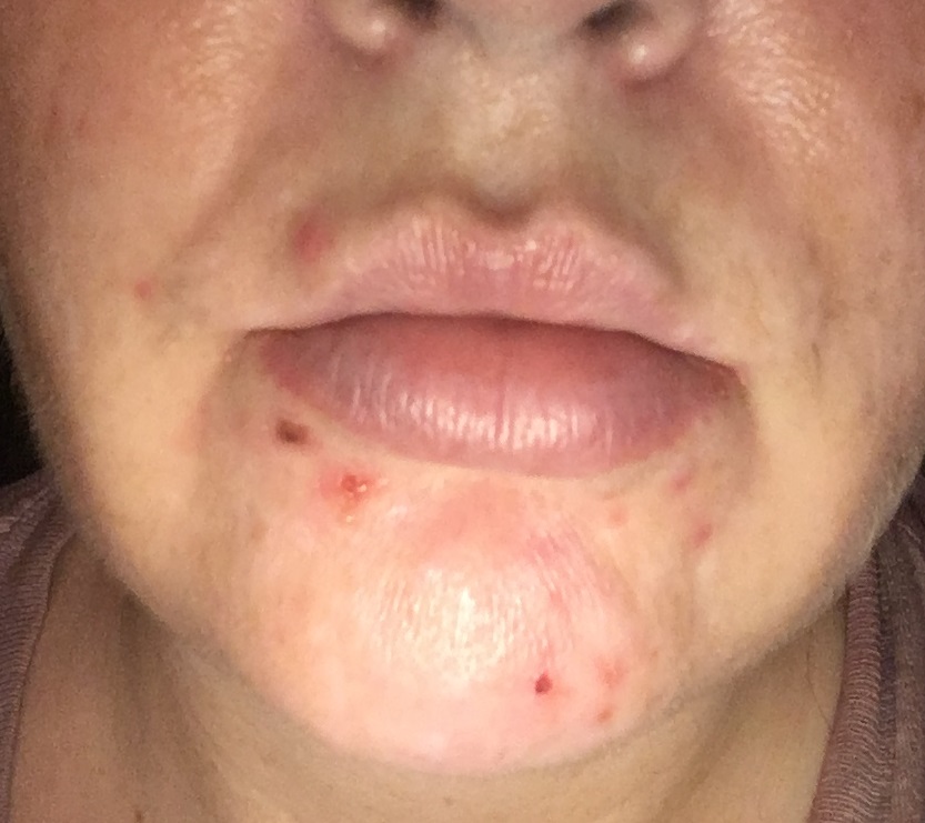 acnefree sensitive skin