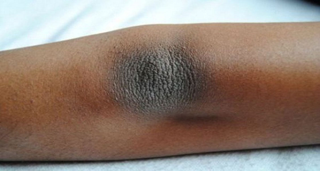Three Simple Ways Of Removing Dry And Dark Skin On The Elbows The