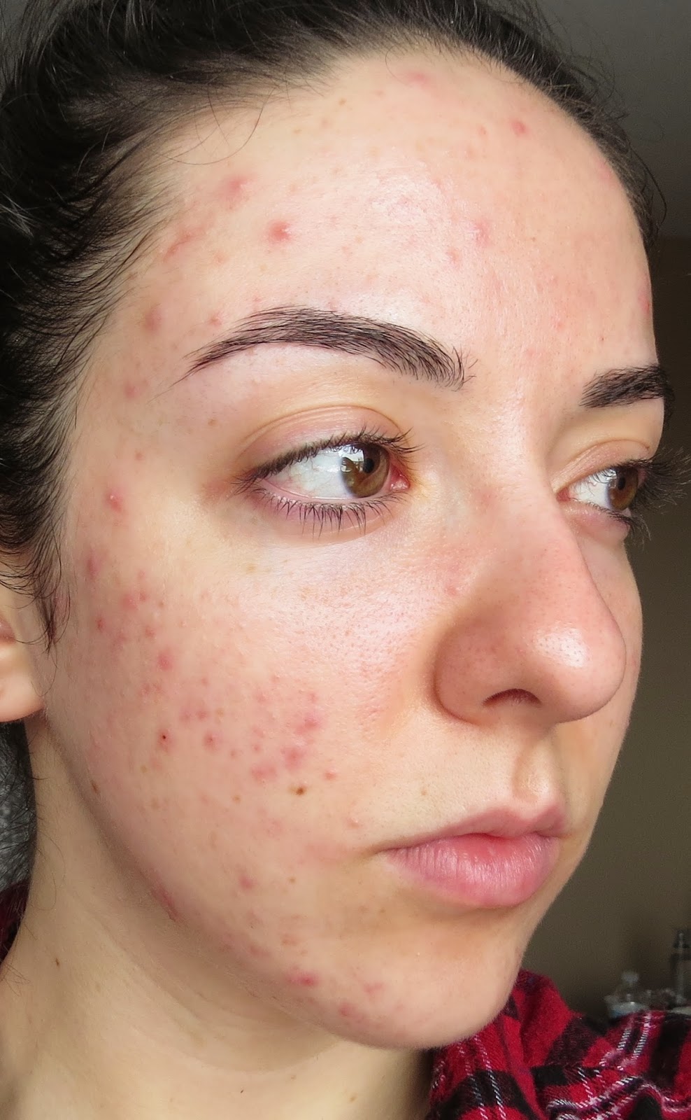my-skin-s-journey-week-14-banish-acne-scars
