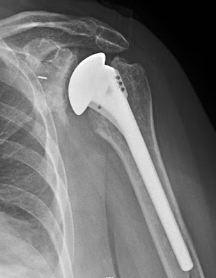Shoulder Arthritis / Rotator Cuff Tears: causes of Shoulder Arthritis / Rotator Cuff Tears: causes of