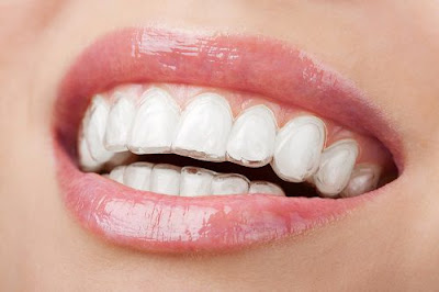 Niềng răng không mắc cài có đắt không?