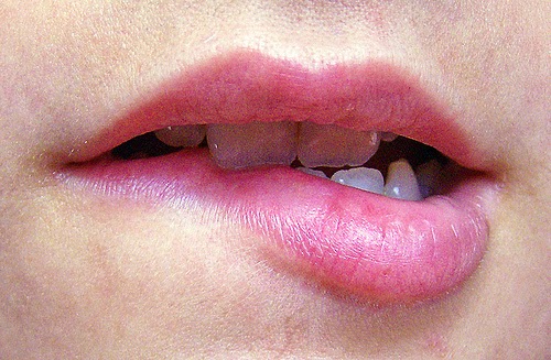     Caring for your lips  • In the cold wintry months the lips become dry and chapped if not taken care of. In fact, it takes quite a lot of time for coping up with the harsh climatic changes and in this state the only way you can protect your lips from getting dried and chapped is the application of lip balms and moisturizing agents like Vaseline. • If you try to opt for using lip gloss you can not only provide them the moisture that they need but also to make then appear soft and beautiful. Lip gloss is actually used extensively by women who use it as a cosmetic. You can also use it for both the purposes of making them soft and making them look nice. • Now-a-days people are becoming more conscious of how they can look more attractive and beautiful and as such opting for all possible means to enrich their looks. Lip augmentation, a type of a cosmetic surgery, is becoming popular day by day for making the lips appear perfect and attractive. • Your lips look more beautiful when you wear lipsticks. In fact, wearing lipstick can be regarded as you need to know about the special techniques that are used for applying lipstick. • If you don't want to use the beauty products that are available in the market for moisturizing your lips, you can try out the home remedies that can help you a lot in retaining the moisture into your lips or soften the lips by providing moisture to them.    For more details & Consultation Feel free to contact us. Vivekanantha Clinic Consultation Champers at Chennai:- 9786901830  Panruti:- 9443054168  Pondicherry:- 9865212055 (Camp) Mail : consult.ur.dr@gmail.com, homoeokumar@gmail.com  For appointment please Call us or Mail Us For appointment: SMS your Name -Age – Mobile Number - Problem in Single word - date and day - Place of appointment (Eg: Rajini - 99xxxxxxx0 – Cracks in Lips  – 21st Oct, Sunday - Chennai ), You will receive Appointment details through SMS