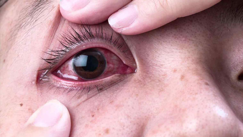 Woman Couldn't See After Salon Used Nail Glue to Apply Lash Extensions