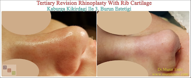 Revision nose aesthetic surgery - Revision nose job in Istanbul - Tertiary nose job in Turkey - - Tertiary rhinoplasty - Tertiary rhinoplasty challenges - Revision rhinoplasty using rib cartilage - Cost of Revision Rhinoplasty in Istanbul - Healing After Revision Rhinoplasty Operation - Revision Rhinoplasty in Istanbul -  Tertiary rhinoplasty using rib cartilage in Istanbul Turkey