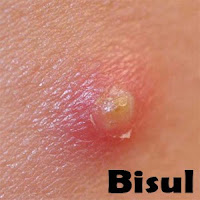 Obat Gatal Bisul Disertai Benjolan Bernanah yang Berkepanjangan