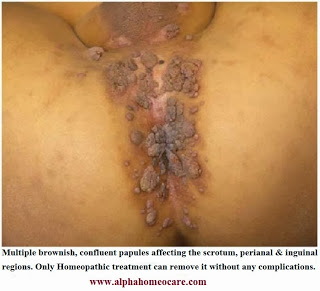 Genital warts cure by Homeopathy