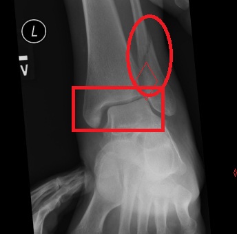 Cat put down after trap breaks bones in paw Michelle broke both ankles: "stress view" x-ray