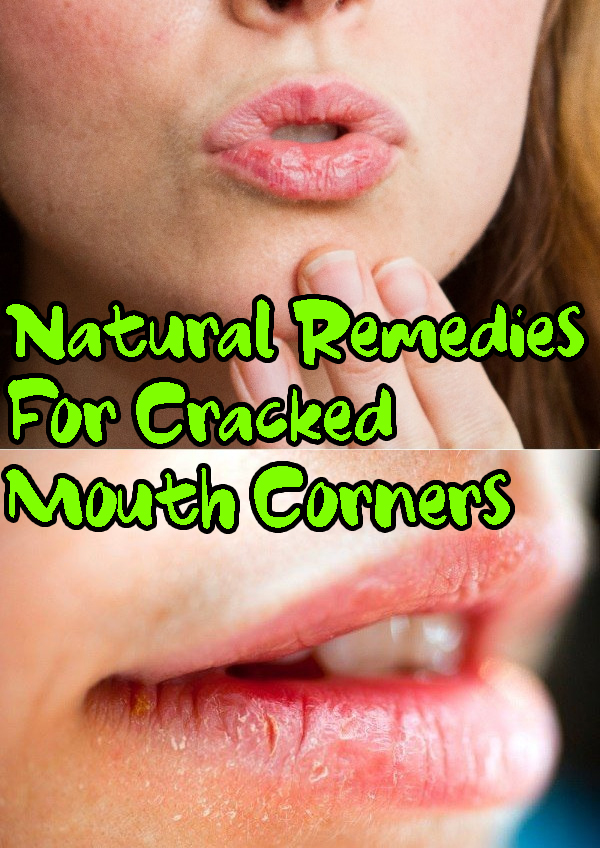 Natural Remedies For Cracked Mouth Corners