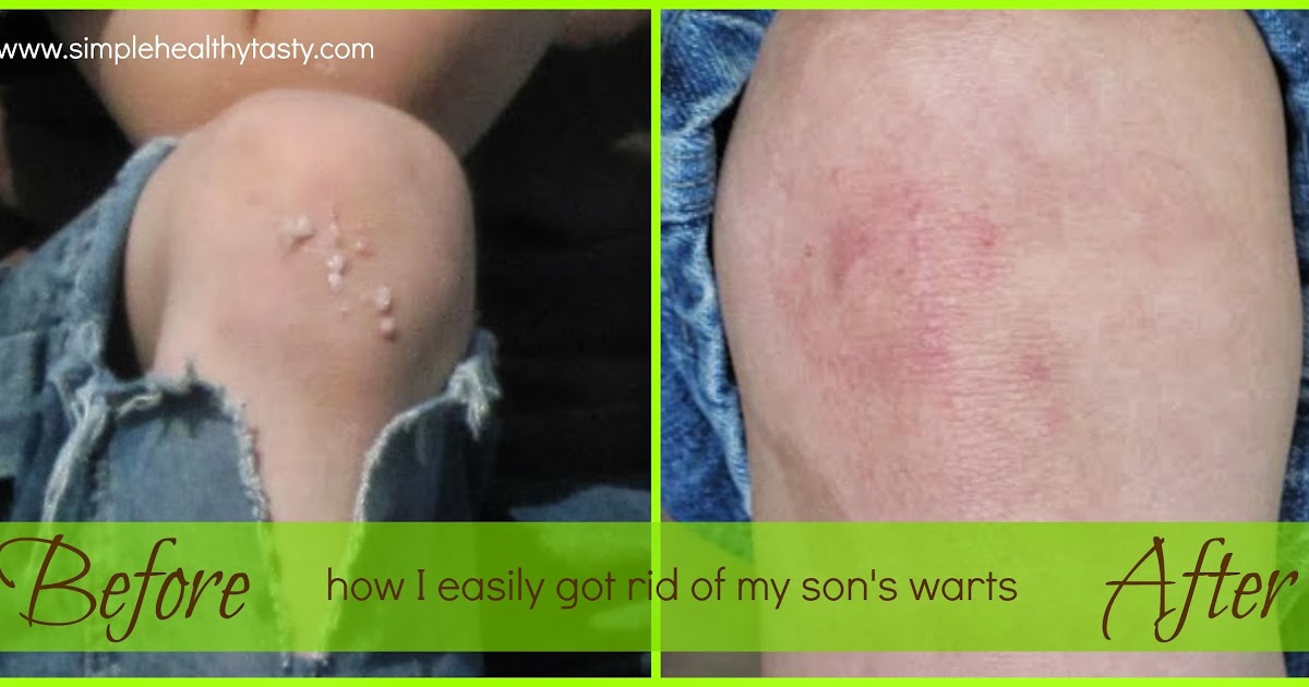 Simple. Healthy. Tasty How to Get Rid of Warts