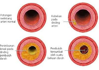 Penyakit Aterosklerosis (Atherosclerosis)
