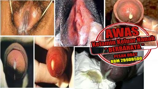 Disini Pengobatan Kencing Nanah Yang Di Jual Online 24 Jam Disini Pengobatan Kencing Nanah Yang Di Jual Online 24 Jam