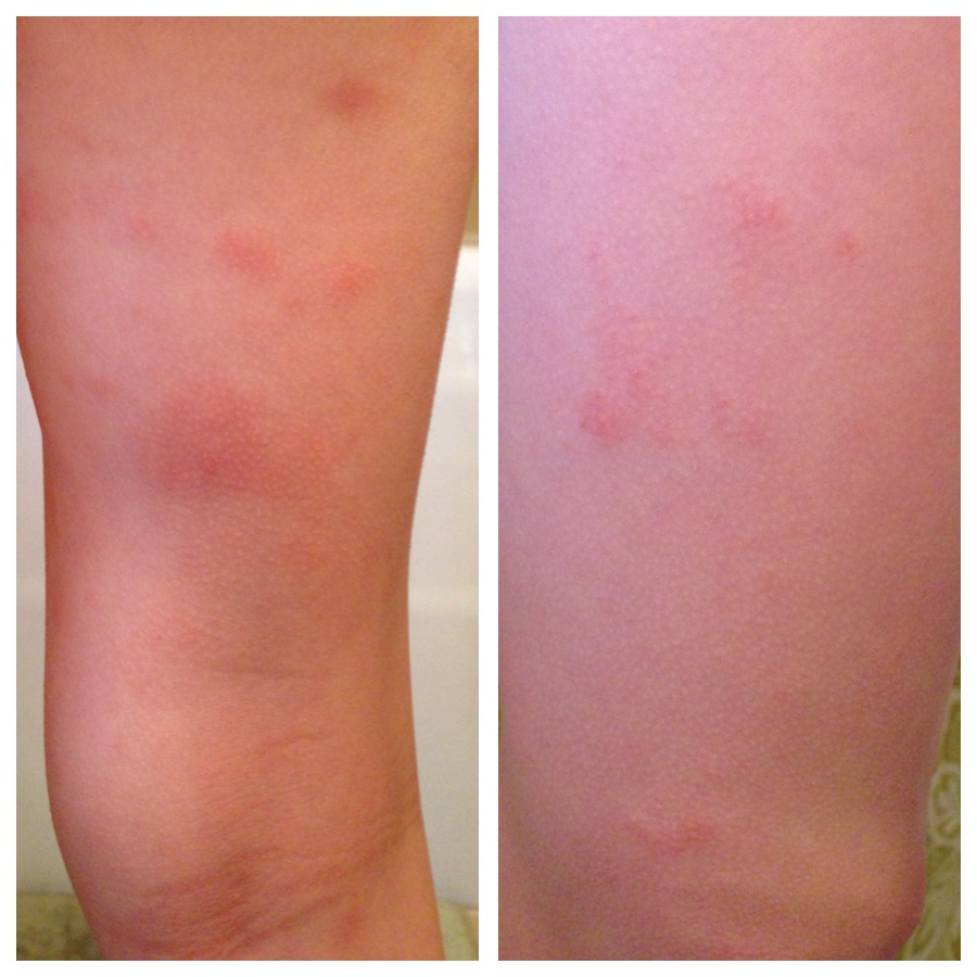 hives on legs pictures, Search.com