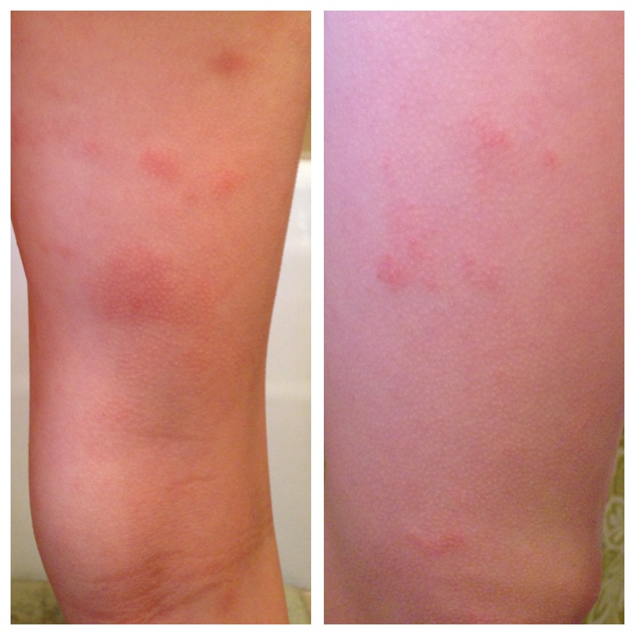 Pictures Of Hives On Legs Pictures Photos