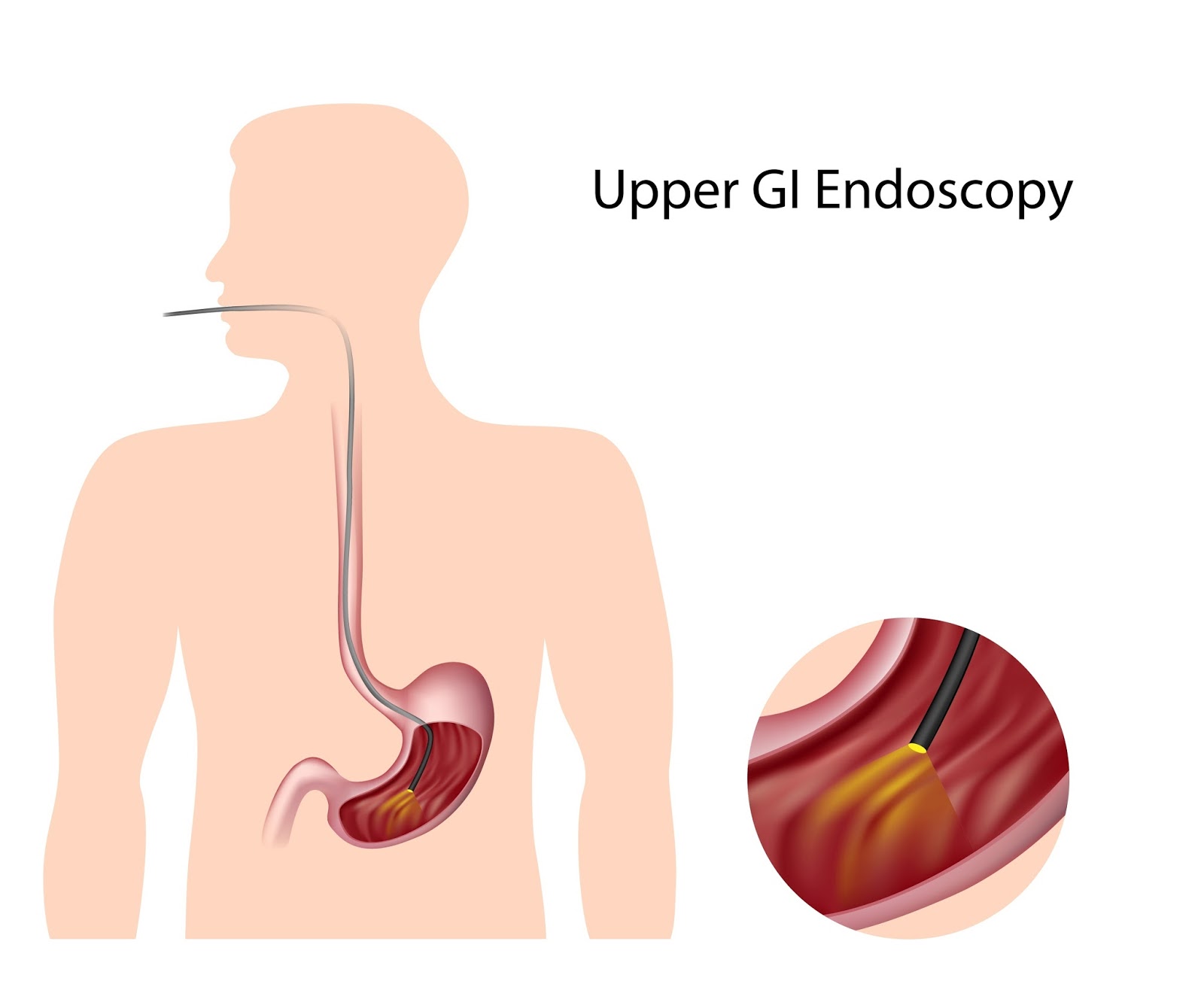 Gi Endoscopy Practice Upper GI Endoscopy and the Disappearing Barium
