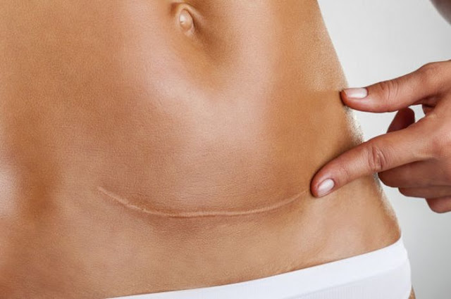 Resiko Tinggi dan Efek Samping Melakukan Operasi Sesar, Nyawa Jadi Taruhan