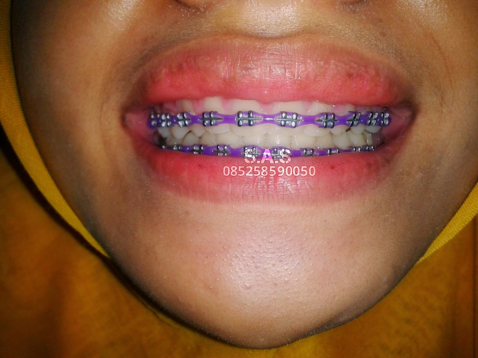 Foto Sebelum dan Sesudah (before After) Perawatan Gigi