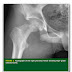 Surgical and Medical Management of Osteosarcoma