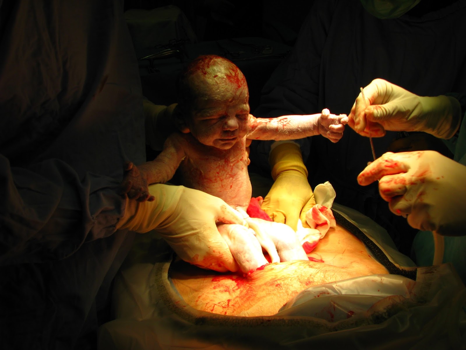 Cara Menyembuhkan Luka Bersalin Pembedahan Dengan Cepat. ~ Cara Hidup Sihat