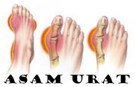 Untuk Menyembuhkan Asam Urat, Apa Nama Obat Tradisional Asam Urat?, Bagaimana Mengatasi Sakit Asam Urat?