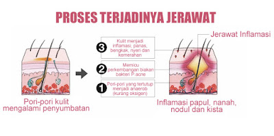 Jerawat Berdasarkan Jenisnya Jerawat Berdasarkan Jenisnya