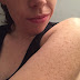 HOME REMEDIES FOR KERATOSIS PILARIS AT HOME FAST