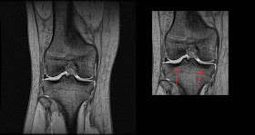 How to read an MRI right knee front view resonata magnetica ACL tear break ligament