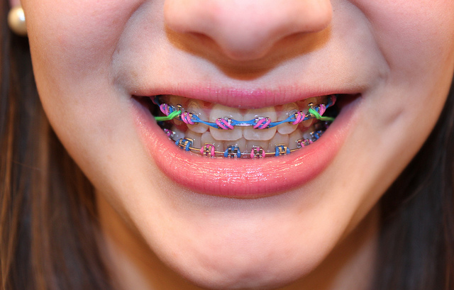 How To Look Your Best With Braces Diva Likes