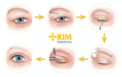 Phương pháp loại bỏ lão hoá da mí mắt hiệu quả