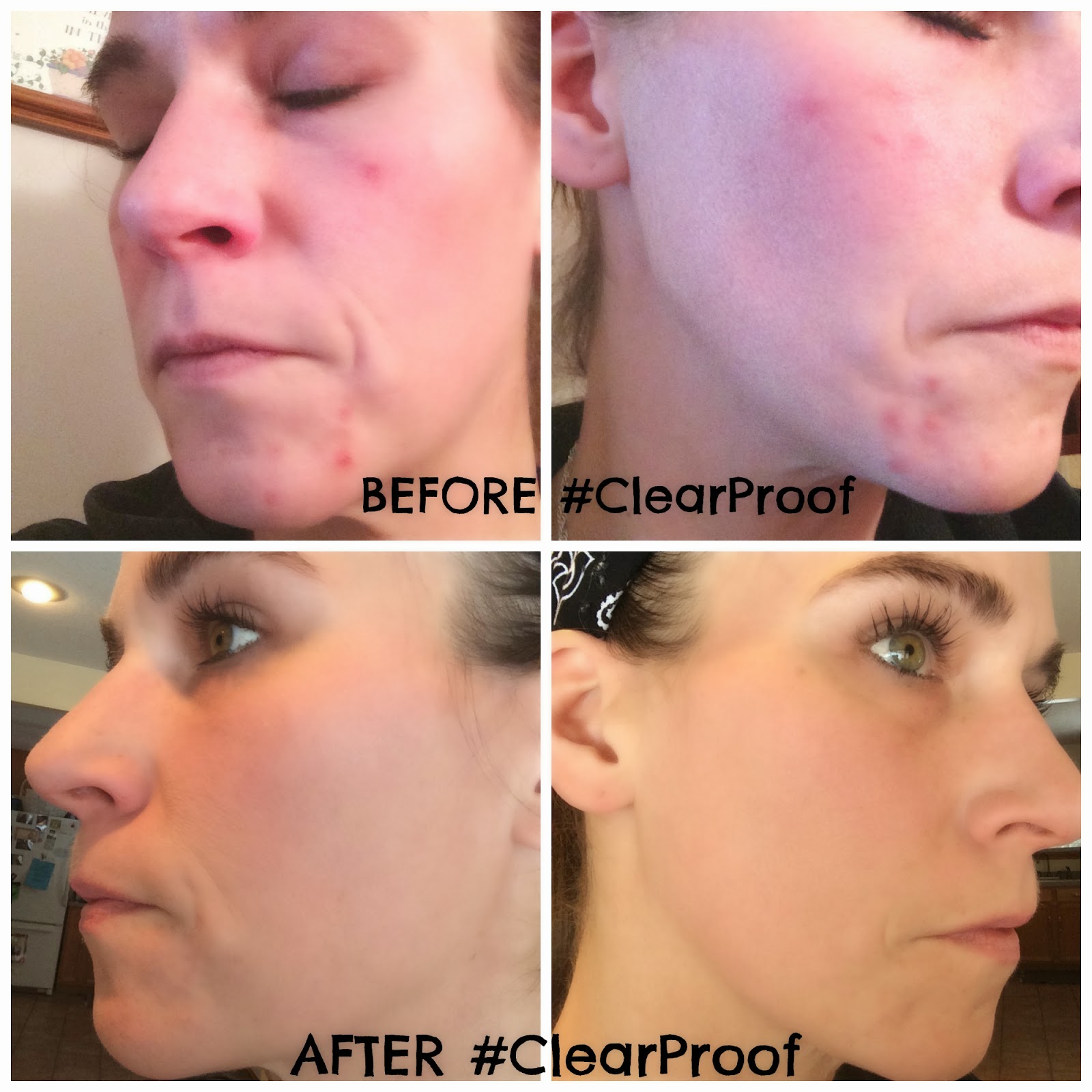 Mary Kay Clear Proof Acne System Review ClearProof A Little Goes A