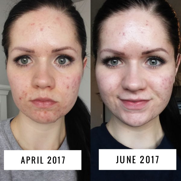how to get rid of acne when nothing works i ve used this twice