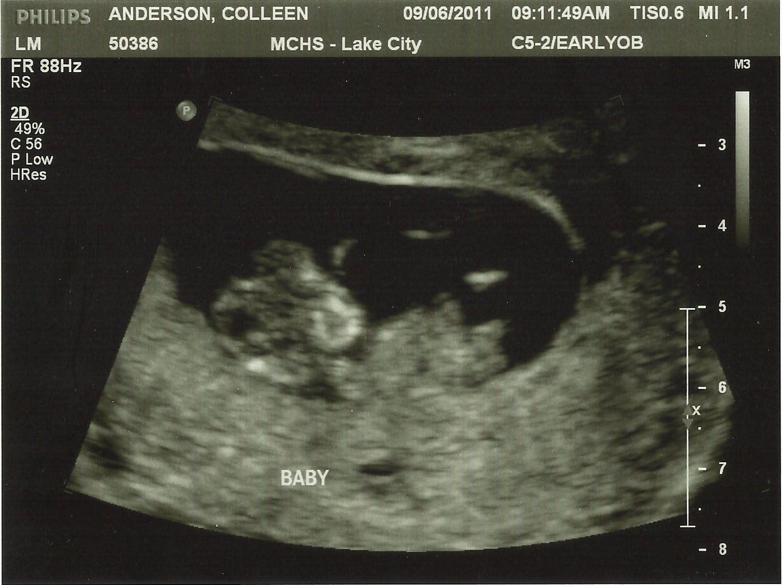 На 11 неделе тянет. 11 Недель беременности. Пол ребенка на 11 неделе беременности. 11 Недель беременности фото. У меня 11 недель беременности.