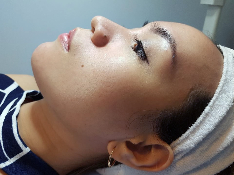 SkinStation: New Korean Treatment for Acne Scars and Wrinkles