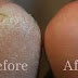 How to treat cracked heel at home?