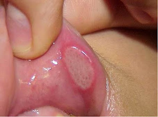 Image NAMA OBAT KENCING NANAH DAN SIPILIS PALING MANJUR