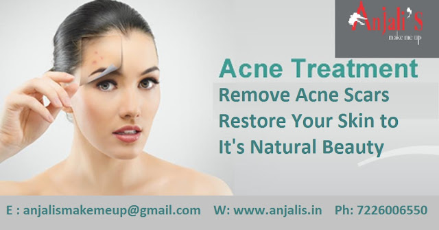 Acne Pro Treatment in Ahmedabad - Anjalis Salon